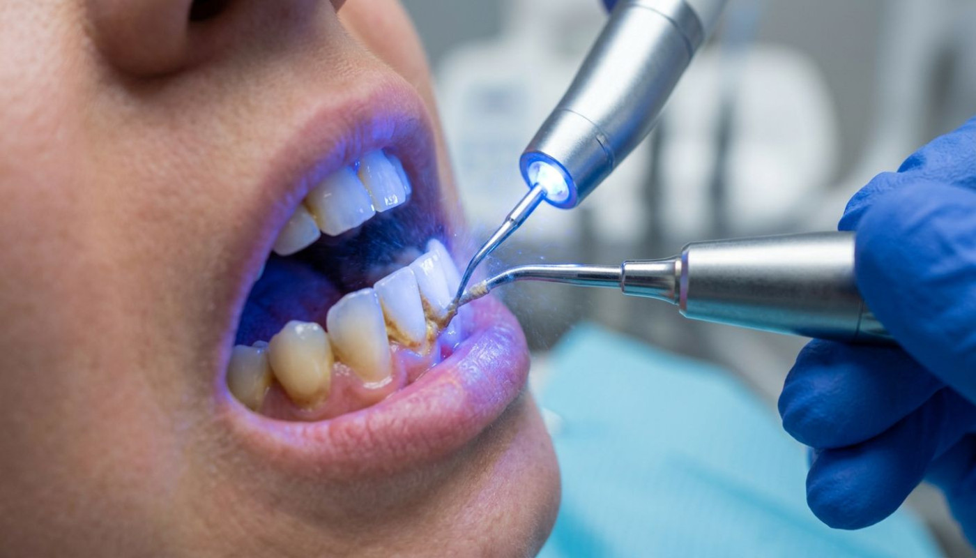 Comment la méthode GBT révolutionne-t-elle le détartrage dentaire ?